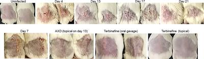 Antifungal activity of alexidine dihydrochloride in a novel diabetic mouse model of dermatophytosis